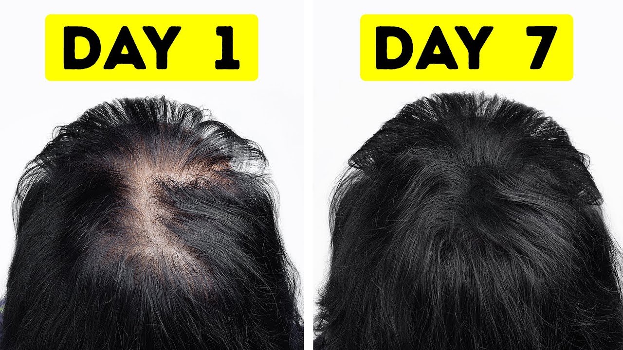 You are currently viewing 2 great ways to thicken hair in a short time!  – Fulcrumy Health Tip
