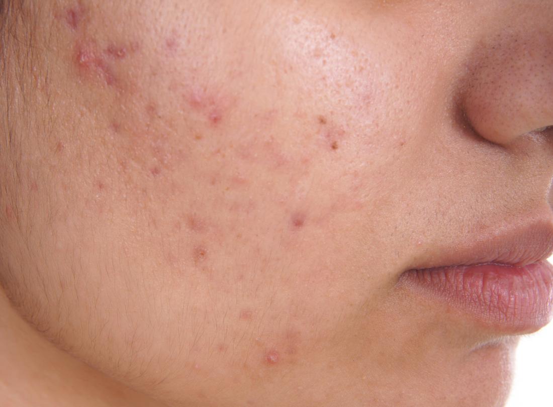 You are currently viewing Acne Problems Acne – DesheBideshe – Fulcrumy Health Tip
