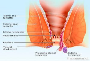 Read more about the article Anal pain, bleeding, rectal swelling, infallible tips to get rid of inflammation