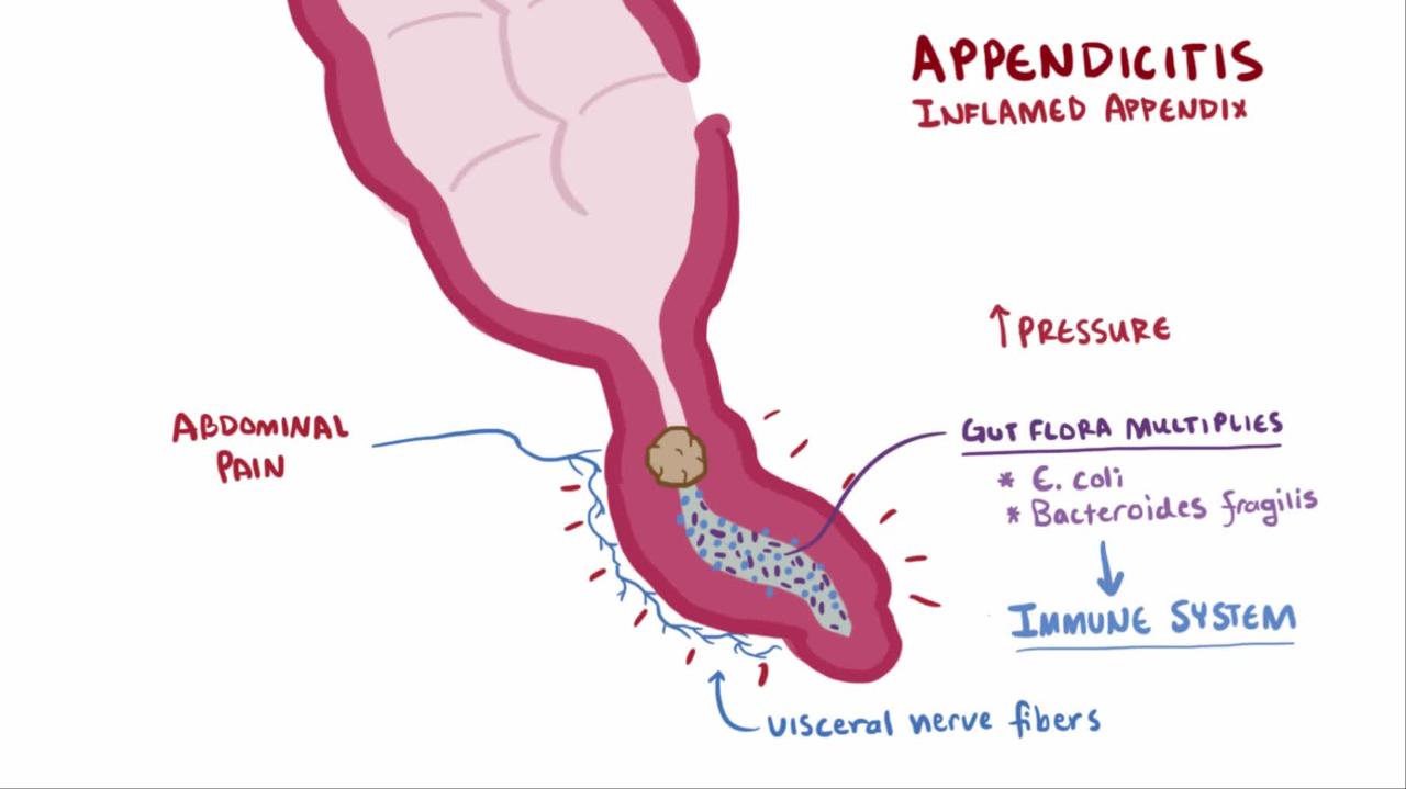 You are currently viewing Appendicitis is the cause of abdominal pain?  Appendicitis is the cause of abdominal pain?