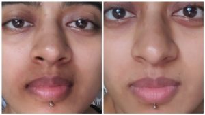 Read more about the article Black spots around the lips?  The solution to the problem – Fulcrumy Health Tip