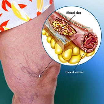 You are currently viewing Blood clots in the body, how do you understand?  – Kolkata24x7 – Fulcrumy Health Tip