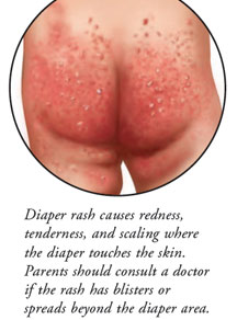 Read more about the article Diaper baby rash, know what to do – Fulcrumy Health Tip