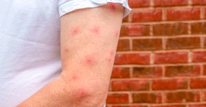 Read more about the article Discomfort of mosquito bites?  Get rid of clutter you don’t need.