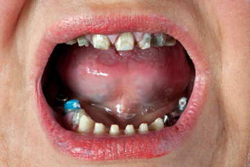 You are currently viewing Don’t brush your teeth with toothbrush or stain, know what to do