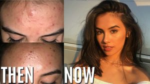 Read more about the article Get rid of acne now – DesheBideshe – Fulcrumy Health Tip