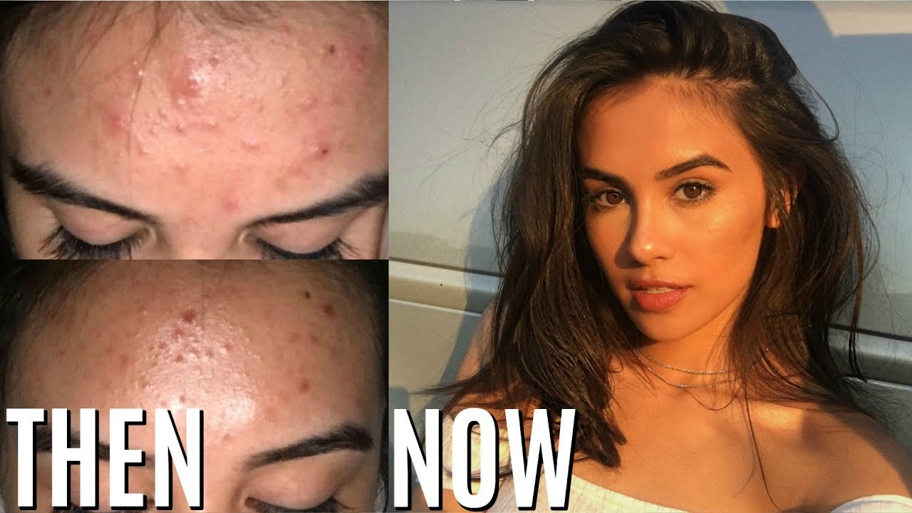 You are currently viewing Get rid of acne now – DesheBideshe – Fulcrumy Health Tip