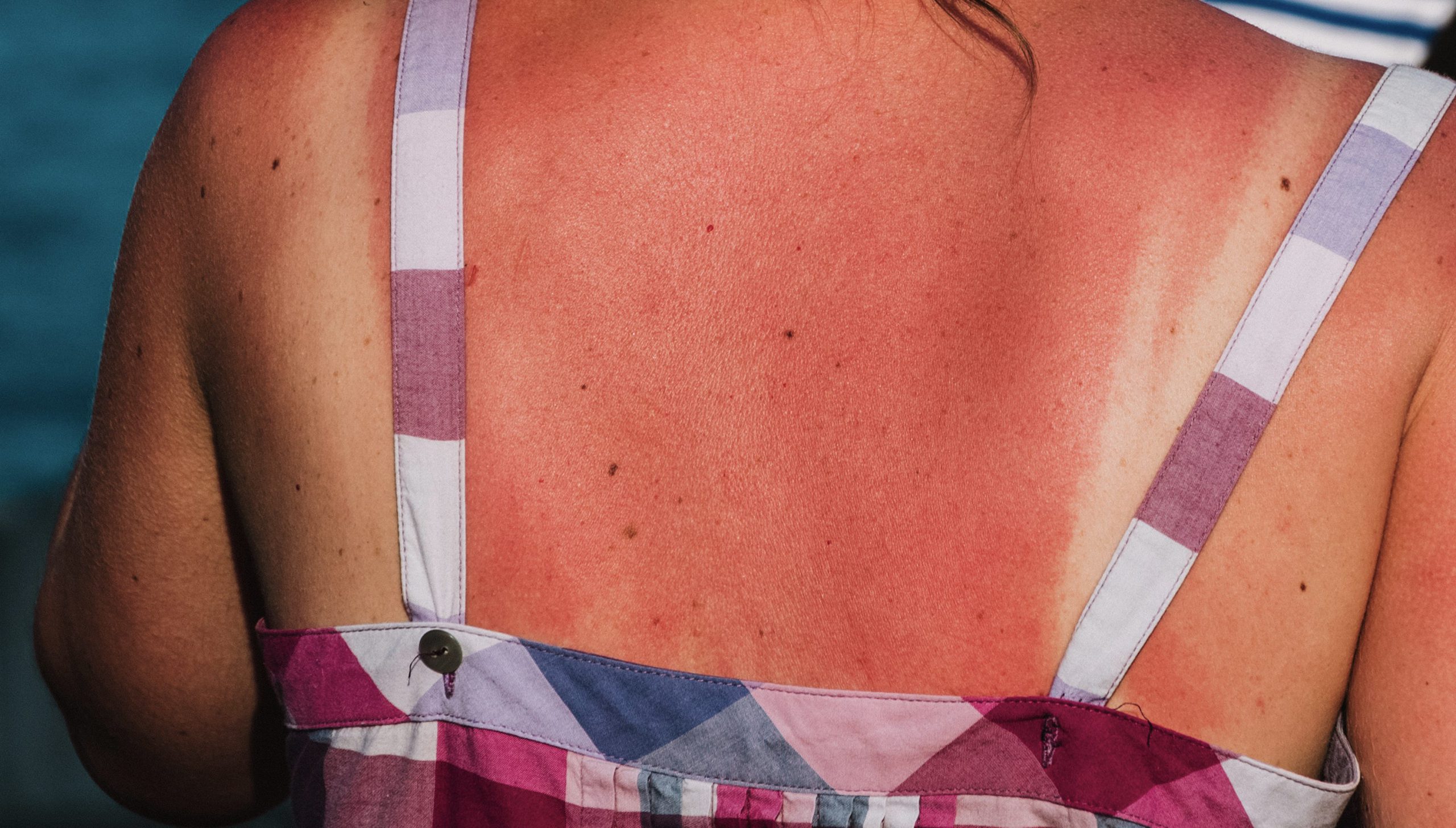 You are currently viewing Get rid of awkward sunburn spots from the skin in just 1 easy way!