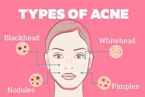 Read more about the article Home Remedies for Acne – Fulcrumy Health Tip
