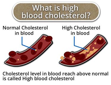 You are currently viewing Increased blood cholesterol?  There is magic in your hands!  – Fulcrumy Health Tip