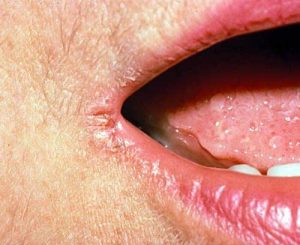 Read more about the article Lip cracking, tongue problems?  If these symptoms appear inside the mouth, it is important to get a COVID test!