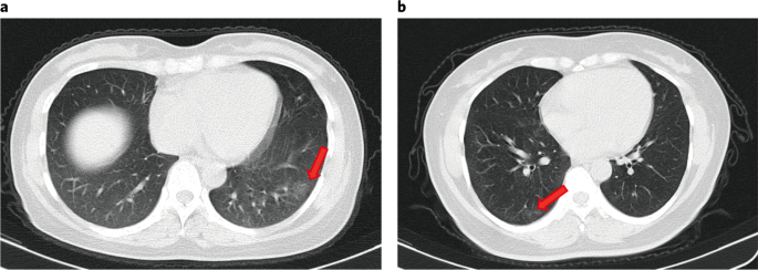 You are currently viewing Silently hit the lungs!  CT scan in Corona –