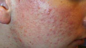 Read more about the article Skin problems can also be symptoms of covid, be careful when you see these symptoms in the body!