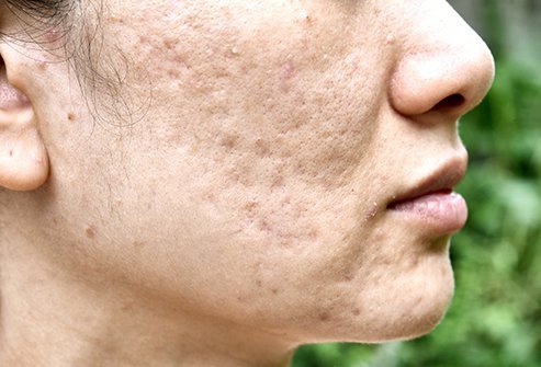 You are currently viewing The problem of acne increases in the rainy season, keep in mind, there is a domestic totka