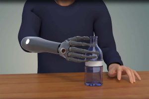 Read more about the article The way the bionic hand changed a life …