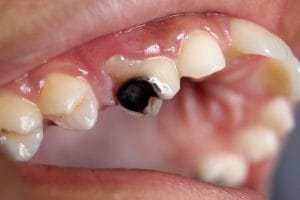 Read more about the article Tooth decay?  Premature erosion?  Follow these 4 easy ways to protect your health
