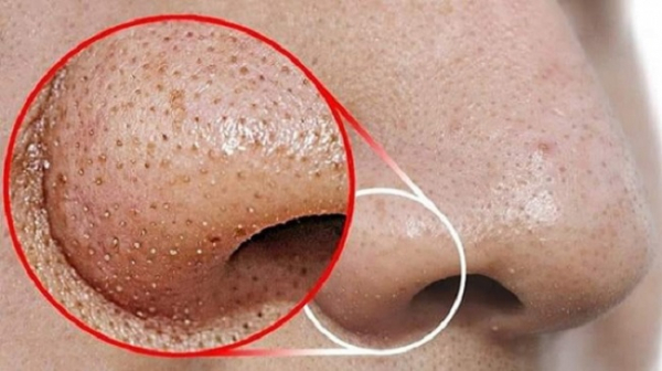 You are currently viewing Two ways to get rid of unwanted facial hair 100% “pain free”!