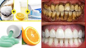 Read more about the article Use lemon to whiten teeth – Fulcrumy Health Tip