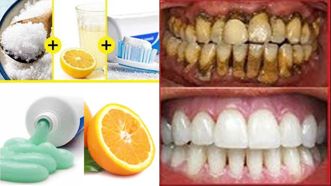You are currently viewing Use lemon to whiten teeth – Fulcrumy Health Tip