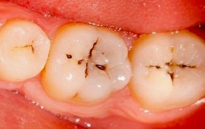 Read more about the article Why Dental Holes, What to Do – Fulcrumy Health Tip